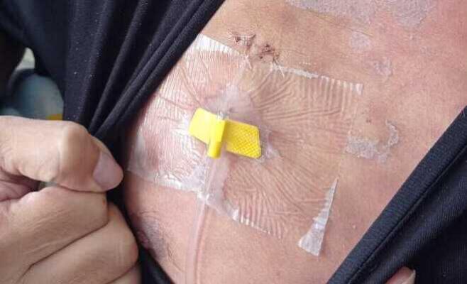 El catéter implantable disminuye enormemente las canalizaciones en los pacientes 